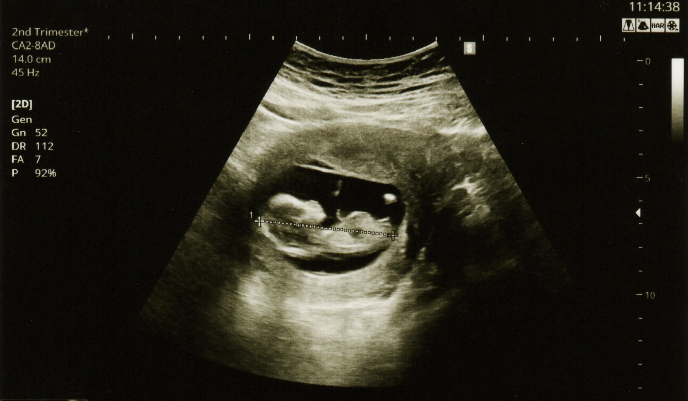 ultrasound at 12 weeks