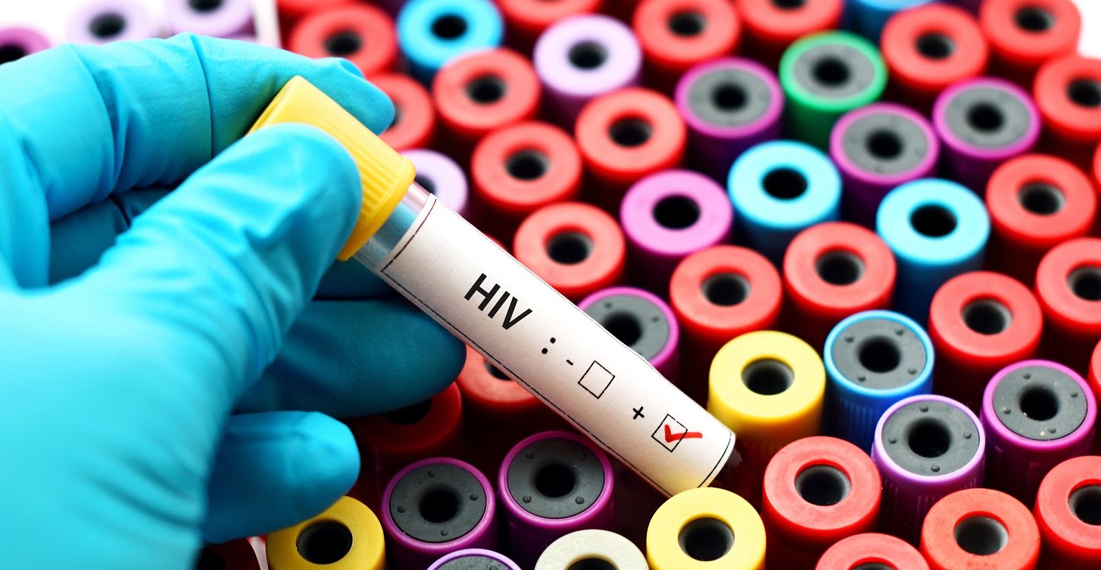HIV positive blood test