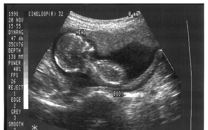 ultrasound four months