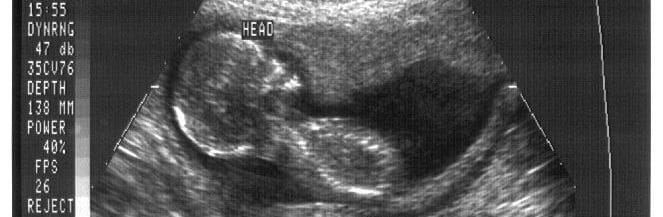 ultrasound four months