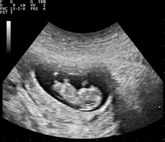 ultrasound image pregnancy