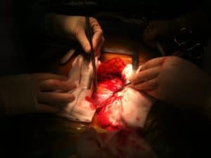 organ donation