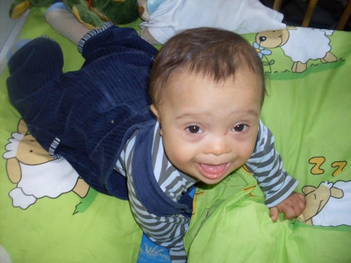 down syndrome baby