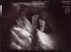 baby feet 22 weeks