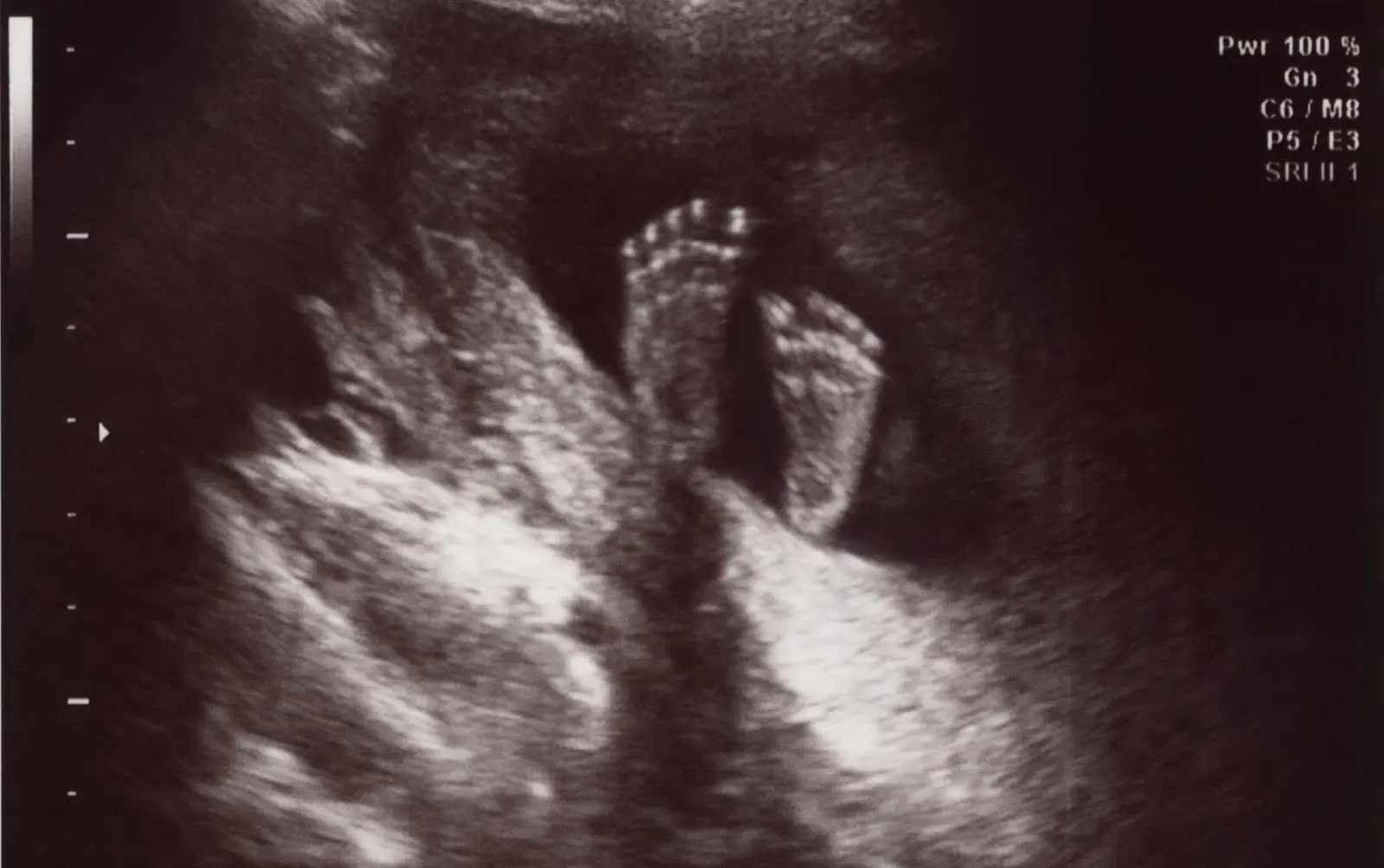 baby feet 22 weeks
