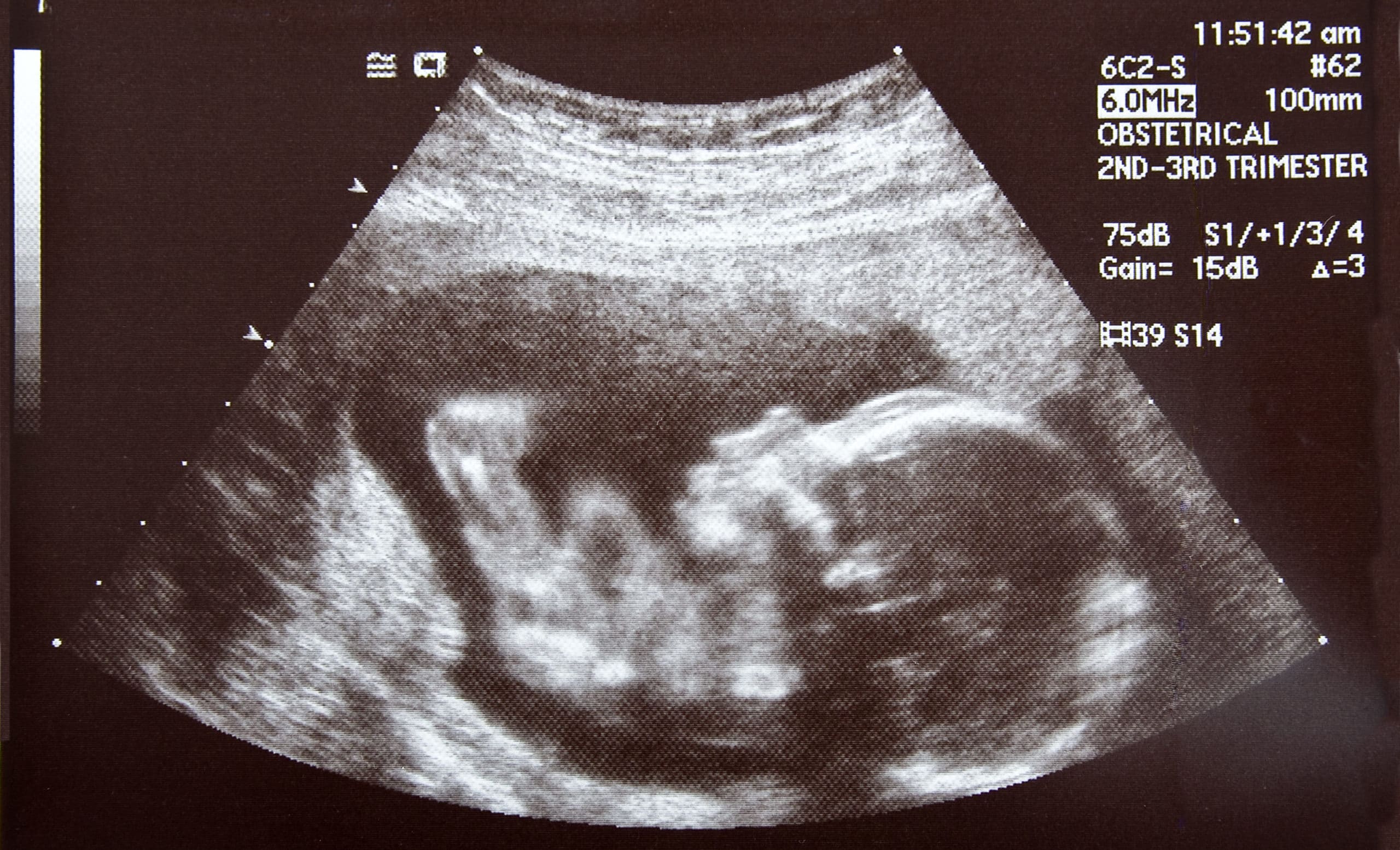 An ultrasound of a human fetus during the 17th week