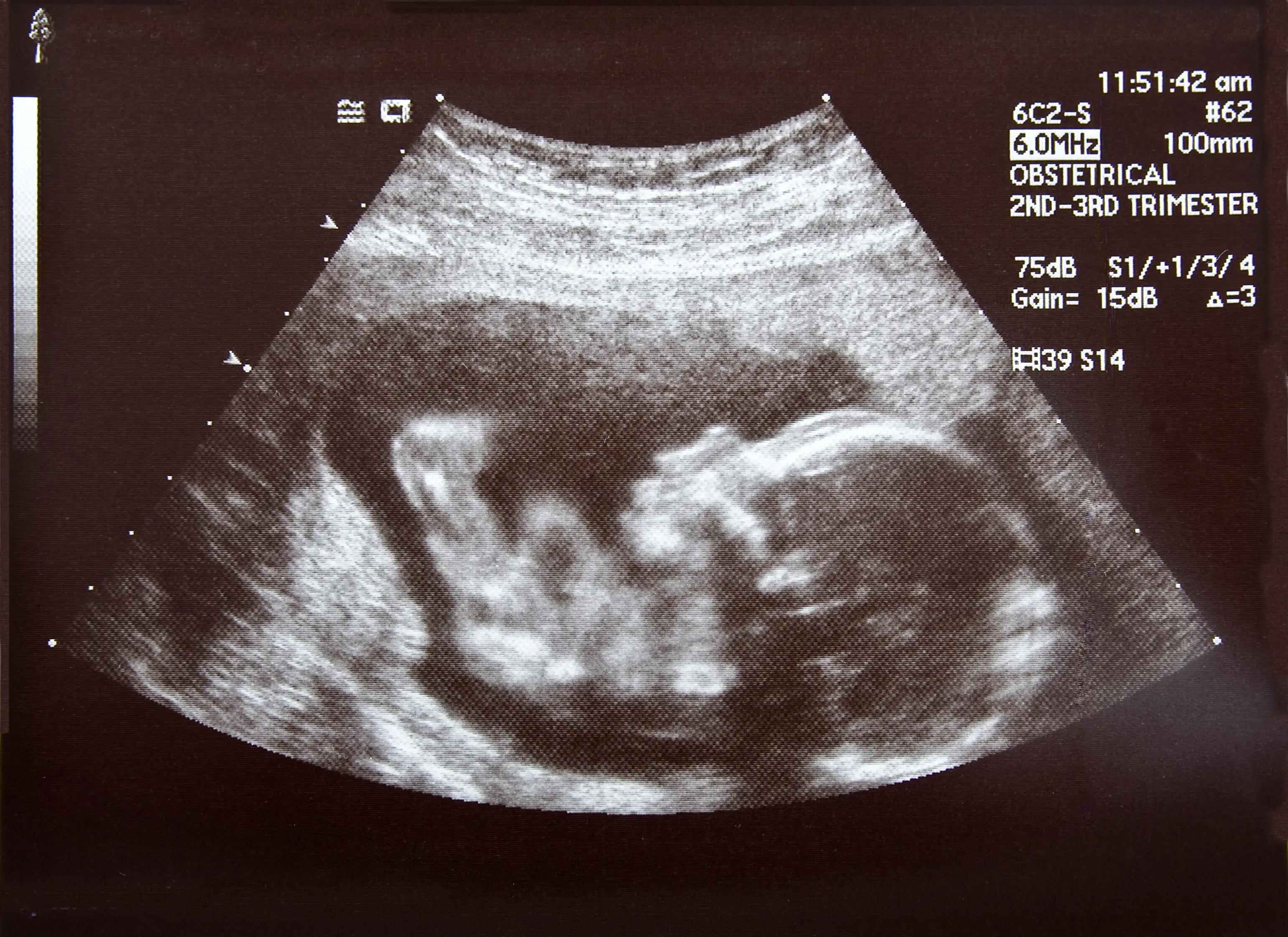An ultrasound of a human fetus during the 17th week