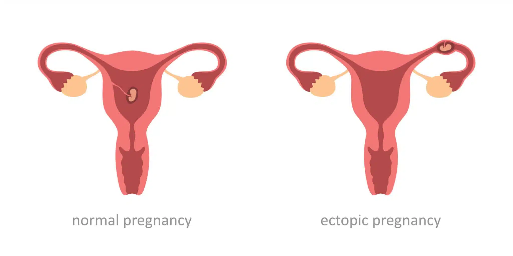 ectopic pregnancy vs normal pregnancy - principle of double effect
