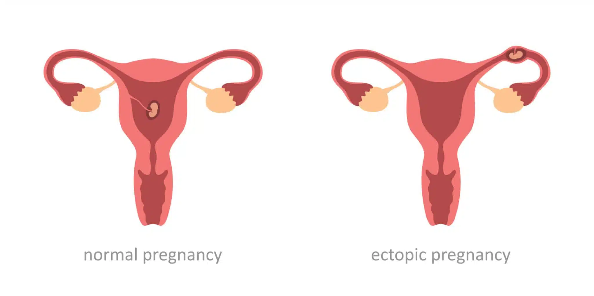 diagram of ectopic vs normal pregnancy