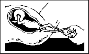 D&X partial birth abortion procedure step 2 Gonzales vs. Carhart