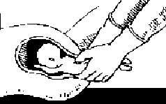 D&X partial birth abortion procedure step 3 Gonzales vs. Carhart