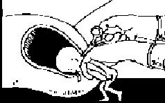 D&X partial birth abortion procedure step 4 Gonzales vs. Carhart