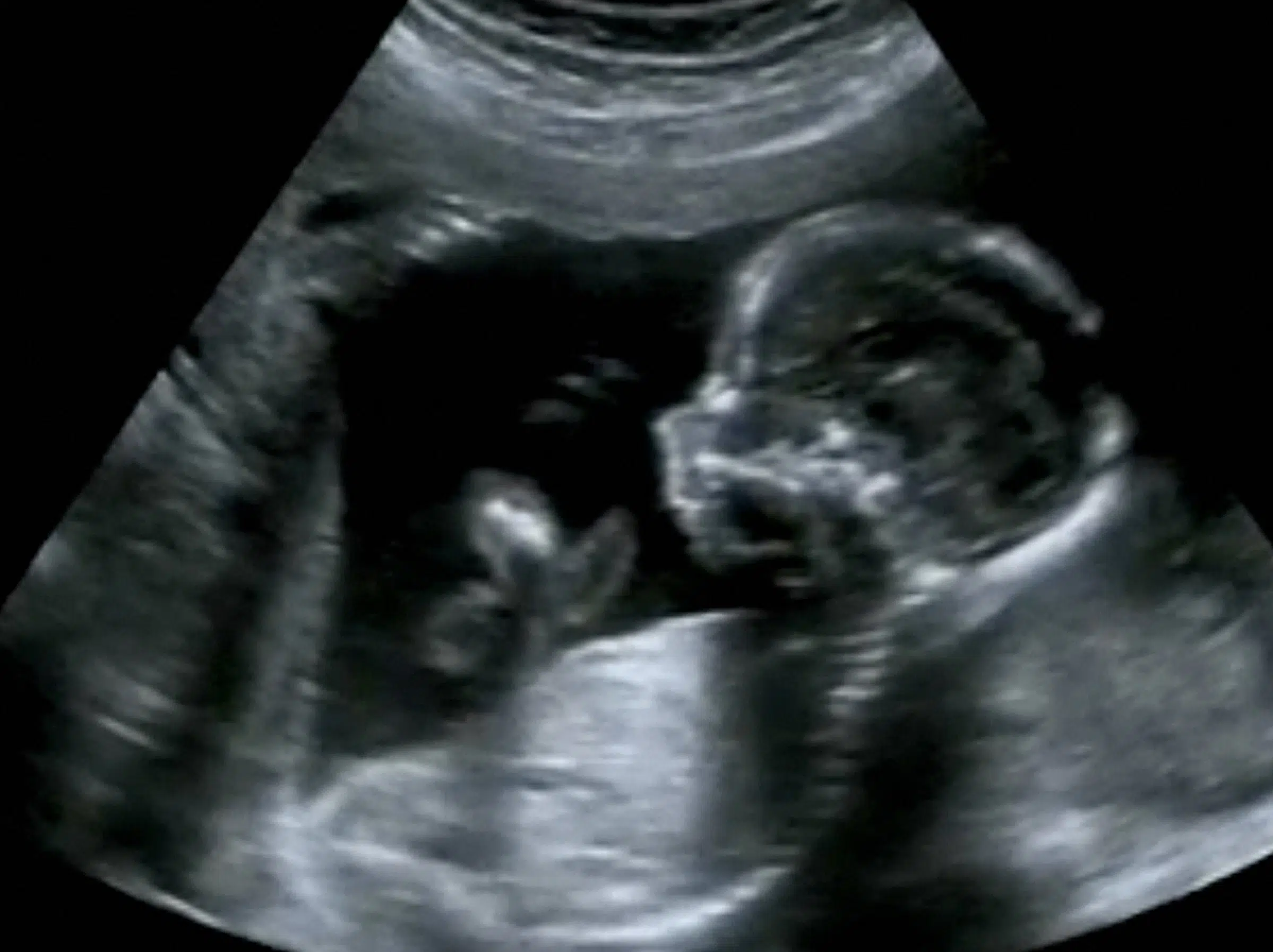 Obstetric Ultrasonography Ultrasound Echography of a baby