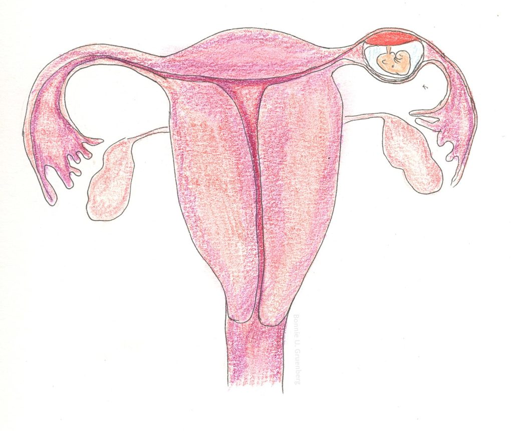 Ectopic pregnancy diagram