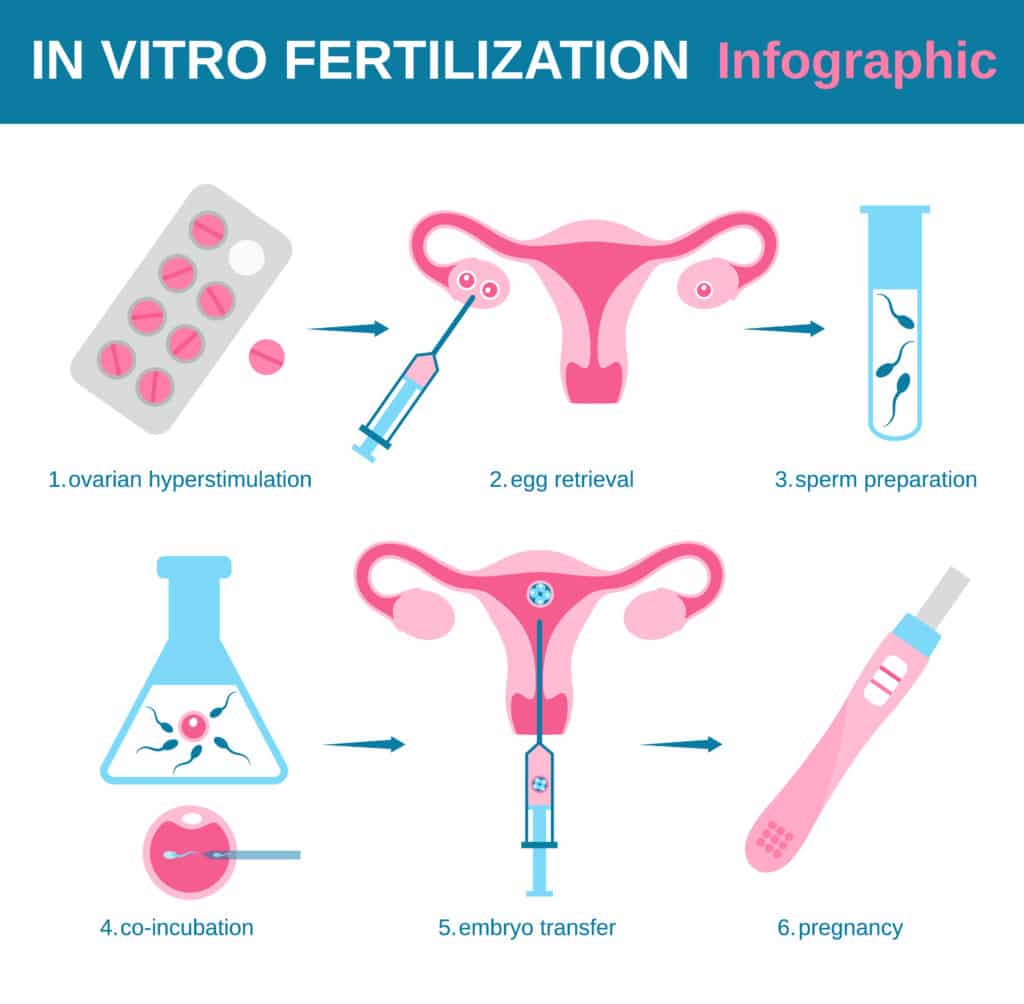 In vitro fertilization. Detailed infographic showing laboratory fertilization of eggs