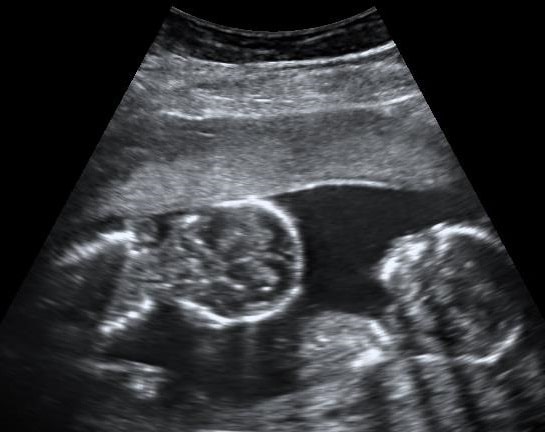 ultrasound of monoamniotic twins at 15 weeks