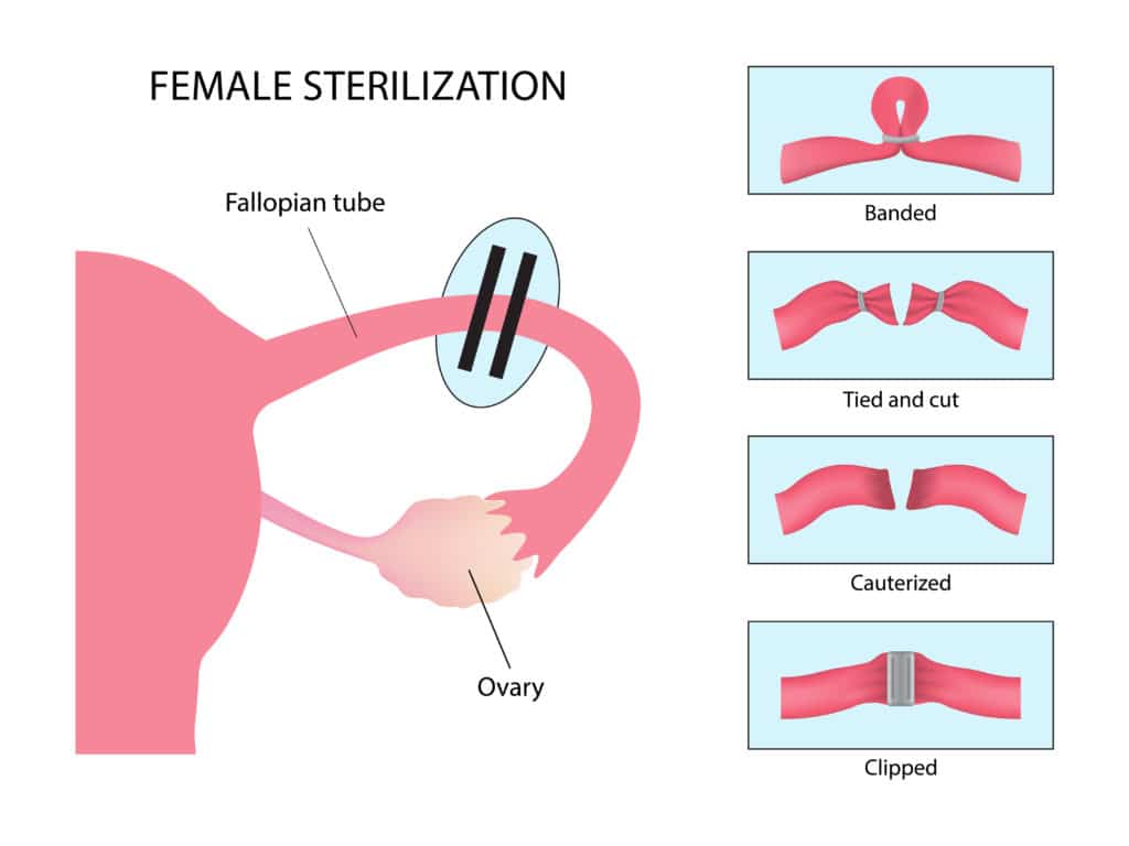 diagram of female sterilization, Tubal ligation