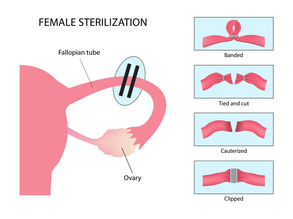 diagram of female sterilization, Tubal ligation