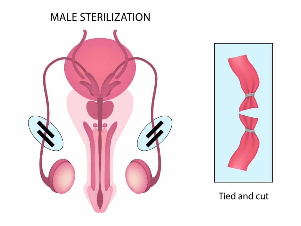 diagram of a male sterilization or vasectomy
