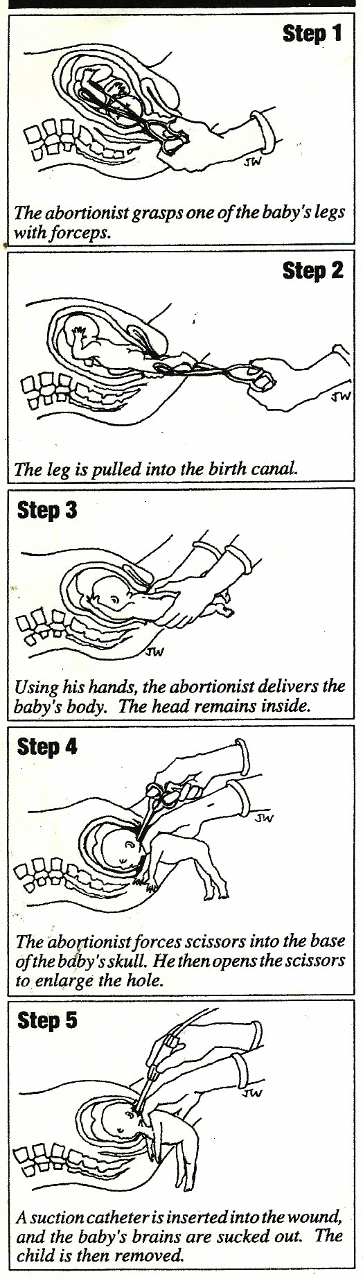 drawings of a D&X (dilation and extraction) abortion procedure, also called partial-birth abortion
