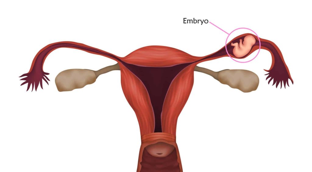 Illustration of an ectopic pregnancy in the fallopian tube