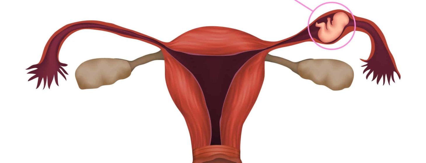 Illustration of an ectopic pregnancy in the fallopian tube