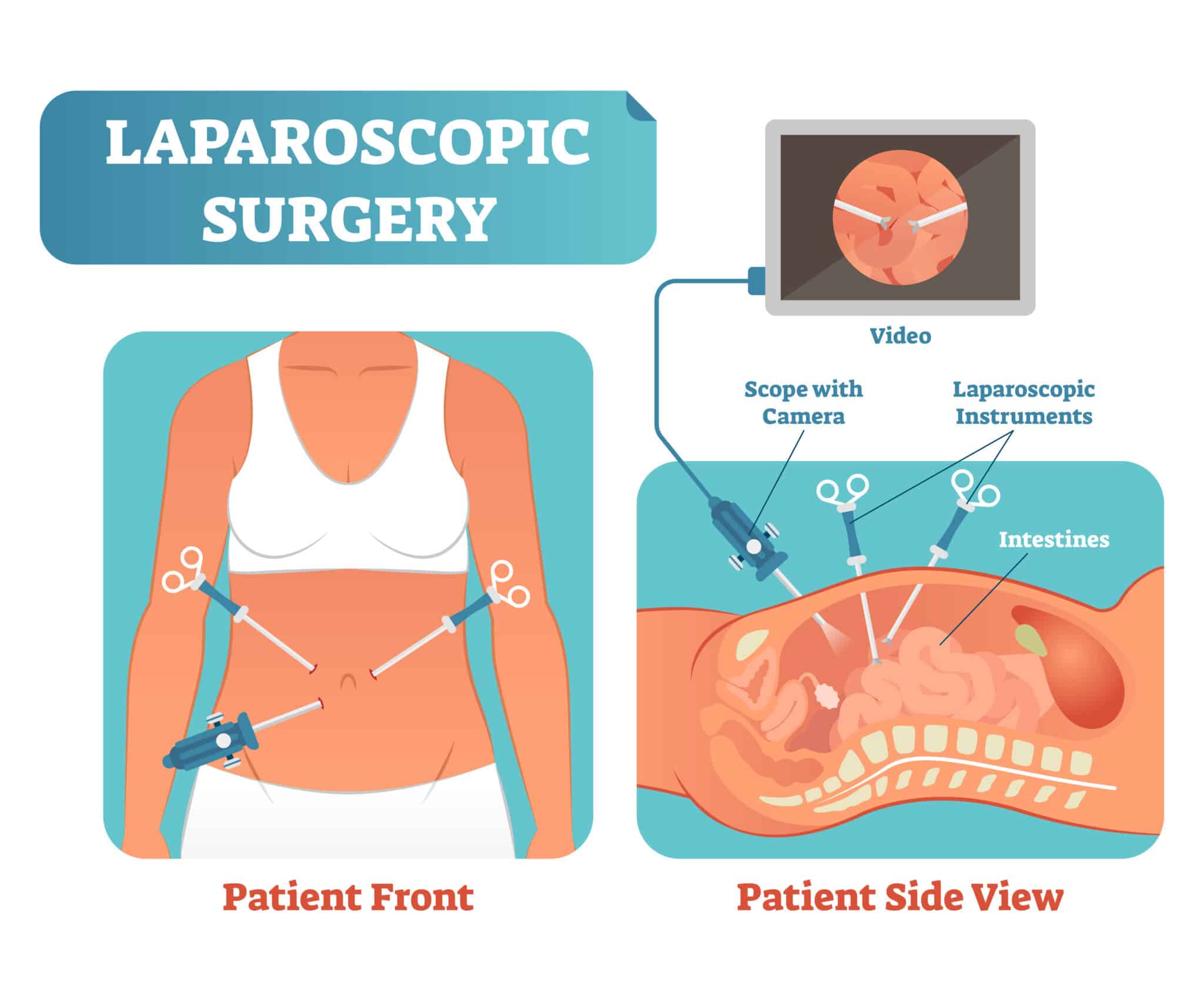 illustration of a laparoscopic surgery